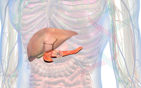 Novas Diretrizes de Prática Clínica para Avaliação e Gerenciamento do Câncer de Pâncreas